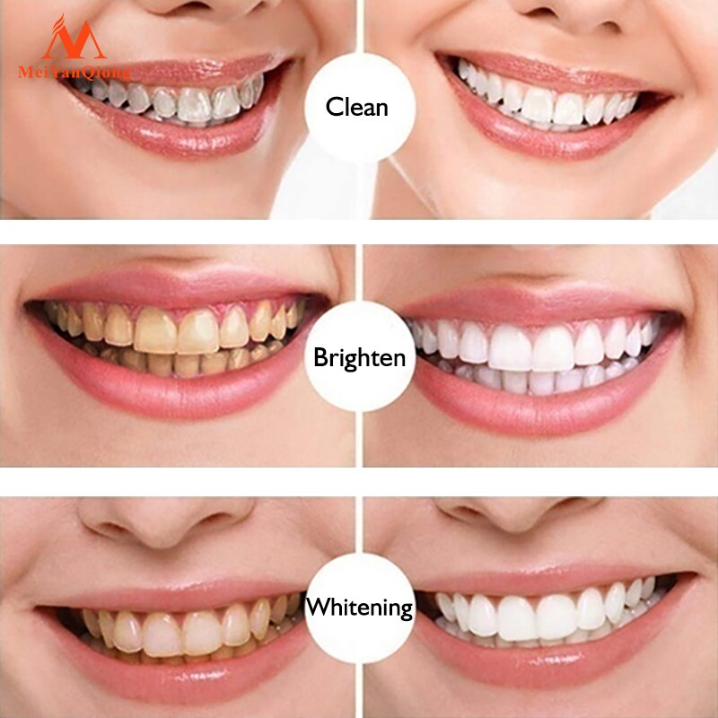 Theet® - Caneta Clareadora Dental