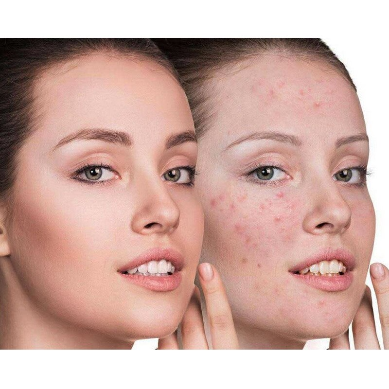 Azelaic® - Nutricosmético para Remoção da Acne