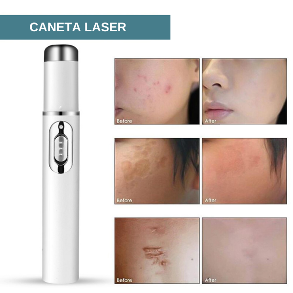 VARILASER - Caneta Laser para Tratamento de Acne e Varizes